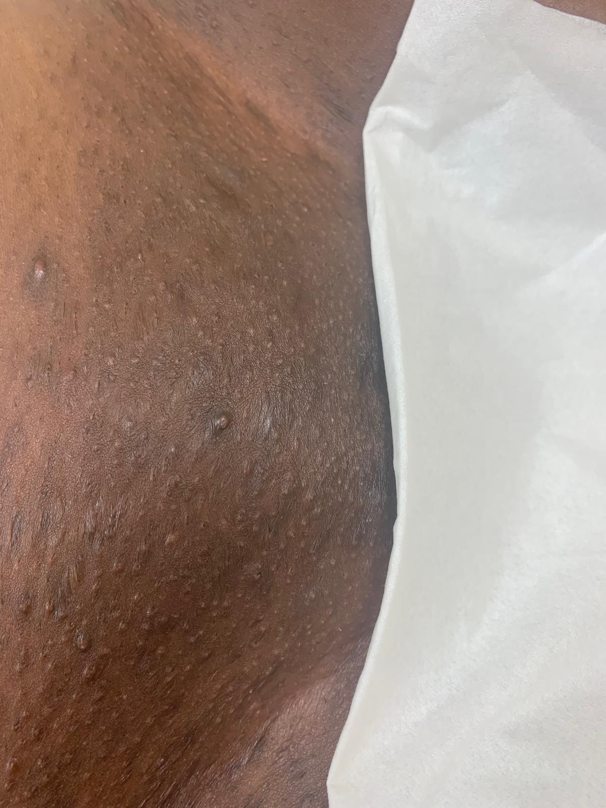 After Brazilian wax treatment, example 3