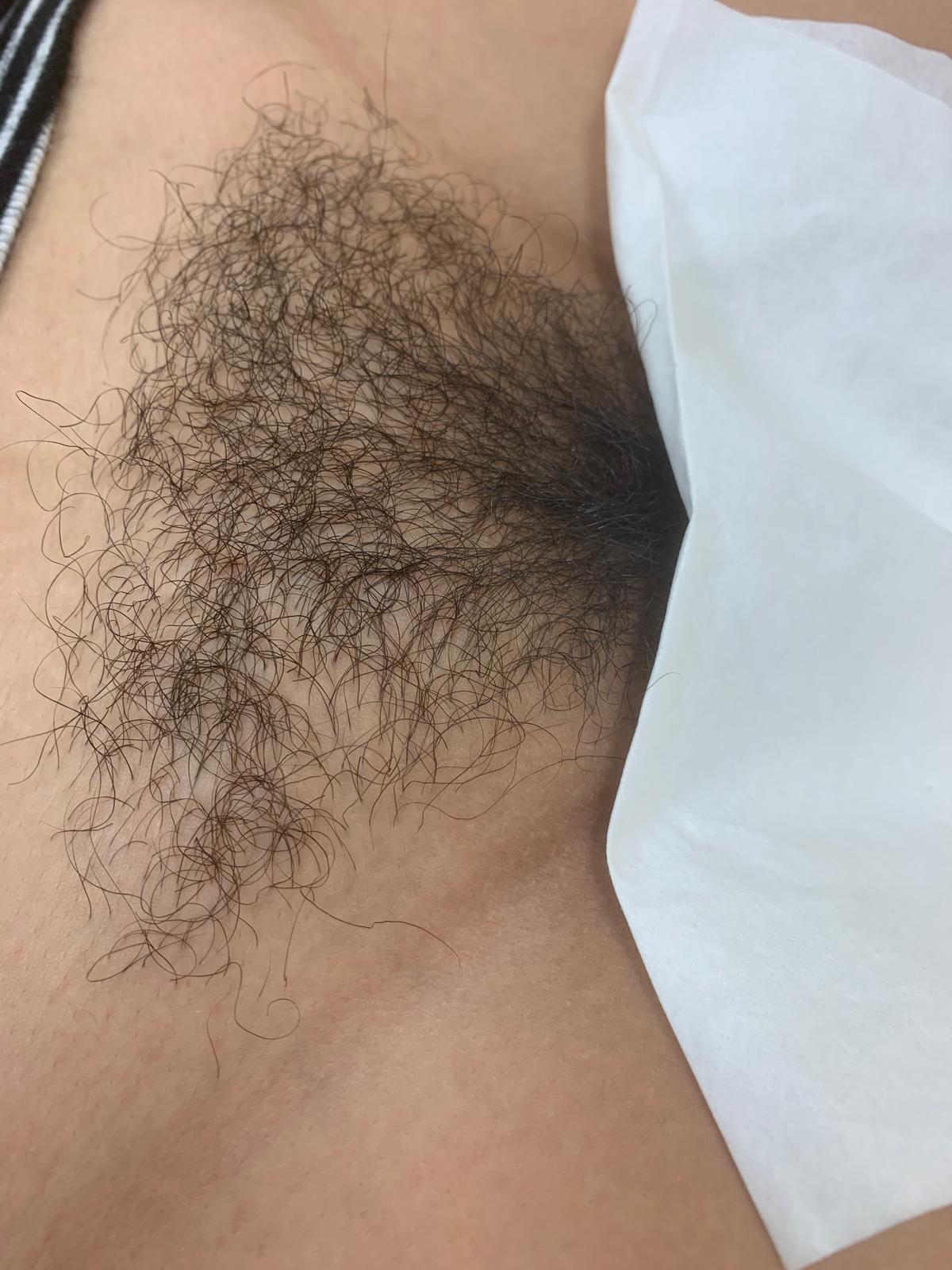Before Brazilian wax treatment, example 2