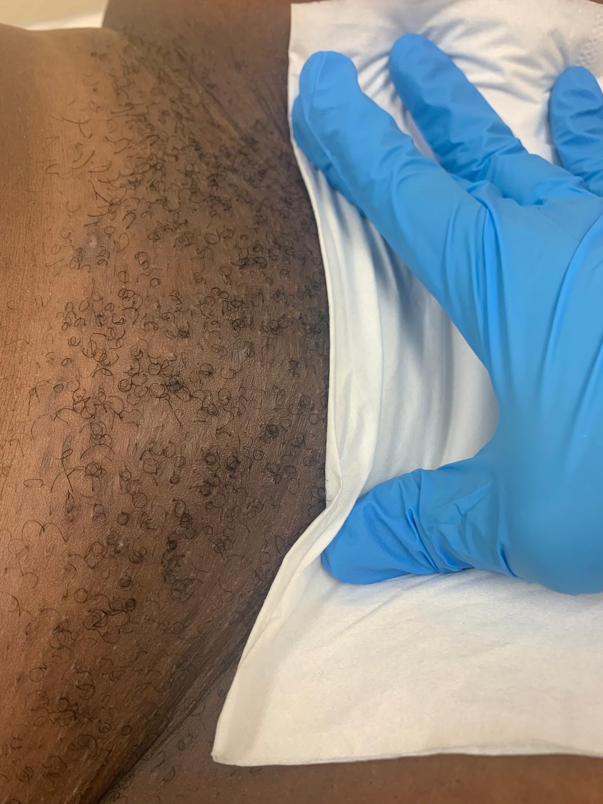 Before Brazilian wax treatment, example 3